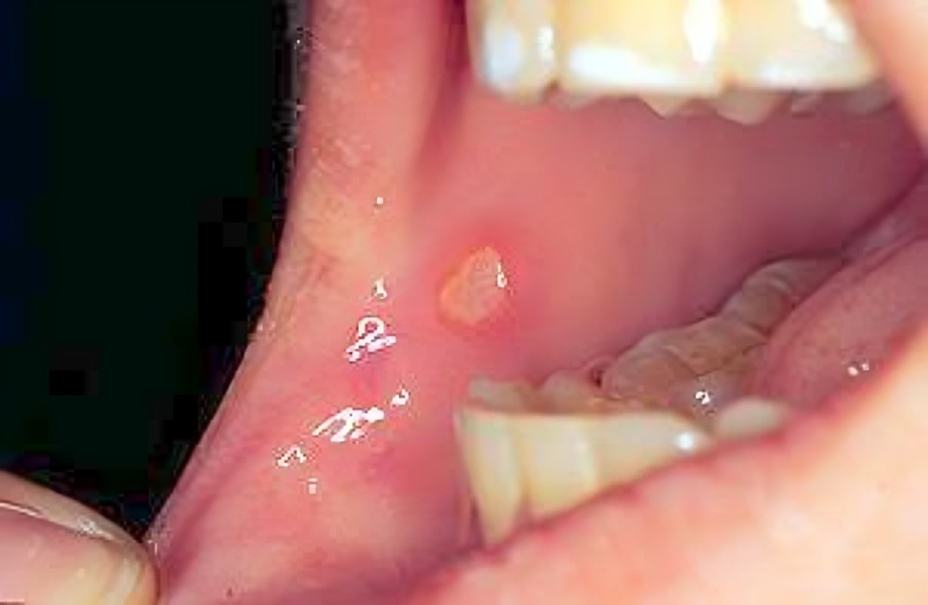 canker