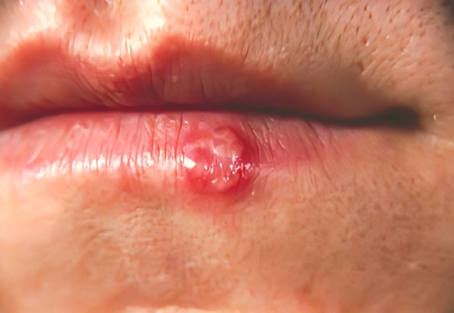 cold-sore