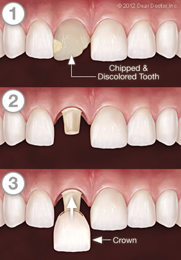 dental crowns near you