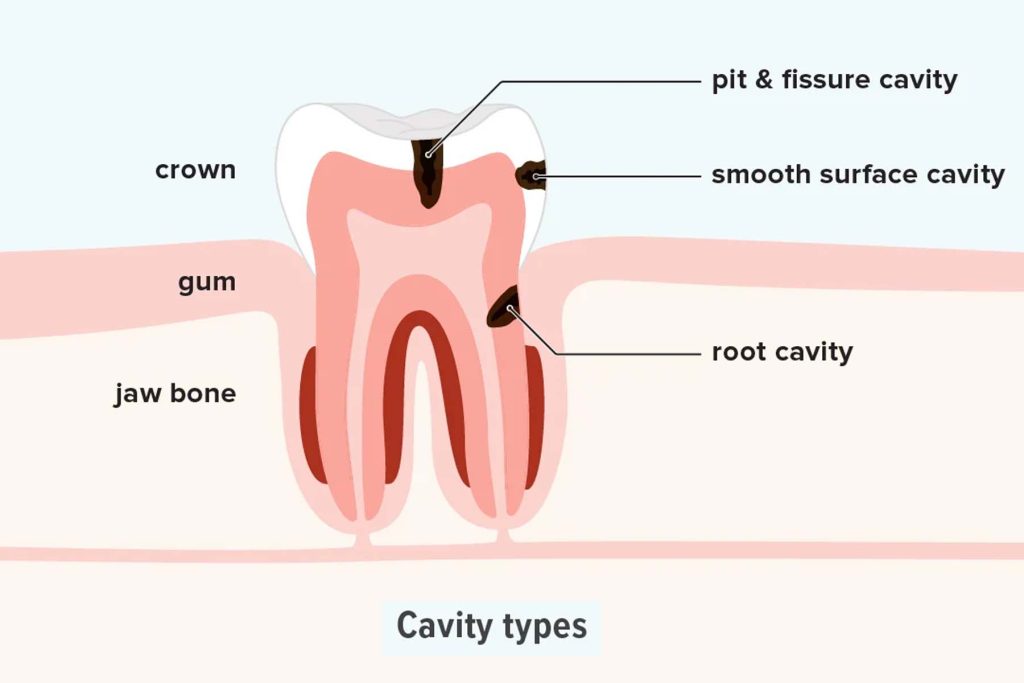 dental fillings victoria