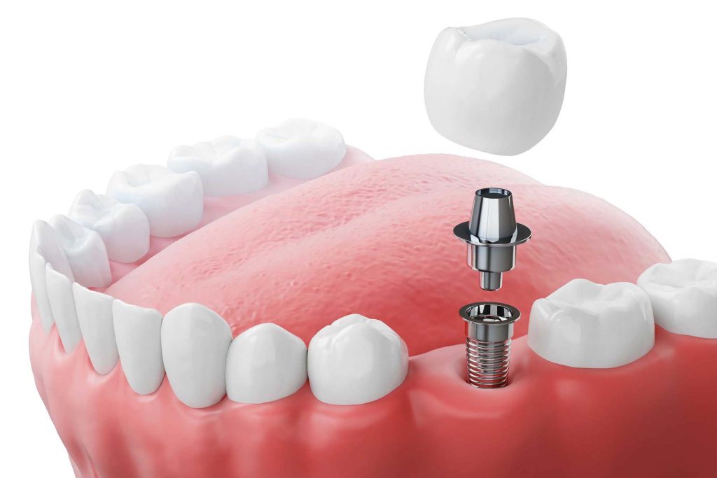 dental-implants-near-you