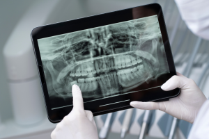 digital dental x ray