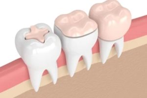 how-inlays-and-onlays-can-restore-your-smile-benefits-and-considerations