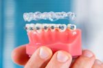how-soon-will-i-see-results-from-braces-or-invisalign