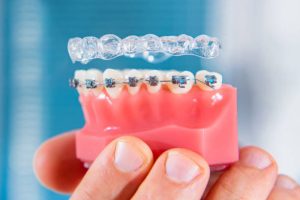 how-soon-will-i-see-results-from-braces-or-invisalign