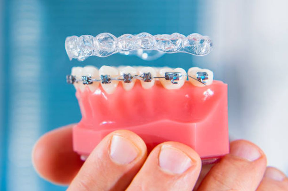 how-soon-will-i-see-results-from-braces-or-invisalign