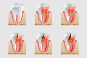 how-vaping-affects-your-teeth-insights-from-a-victoria-dentist