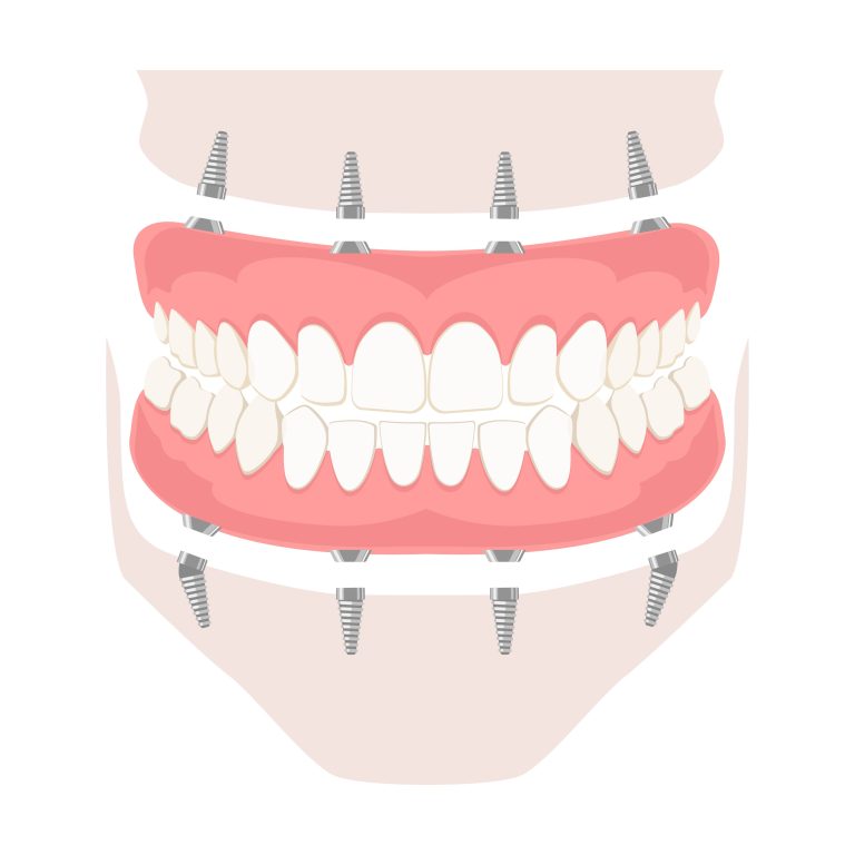 implant supported dentures victoria