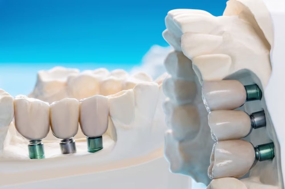why-dental-implants-are-superior-to-traditional-tooth-replacements