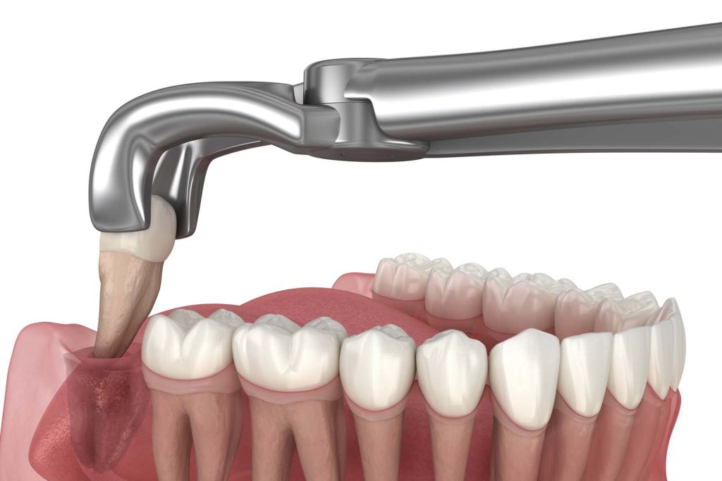 wisdom tooth removal victoria